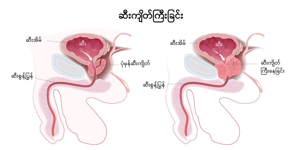 Prostate Gland Enlargement IMG1