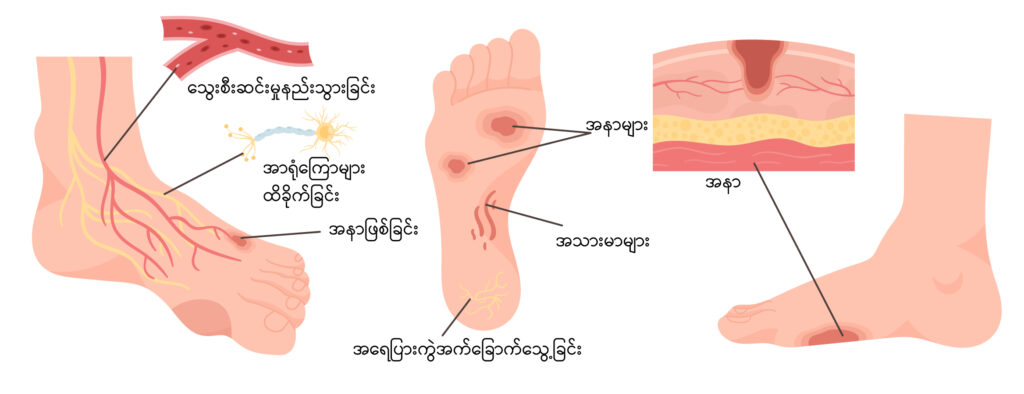 Diabetic foot IMG 1