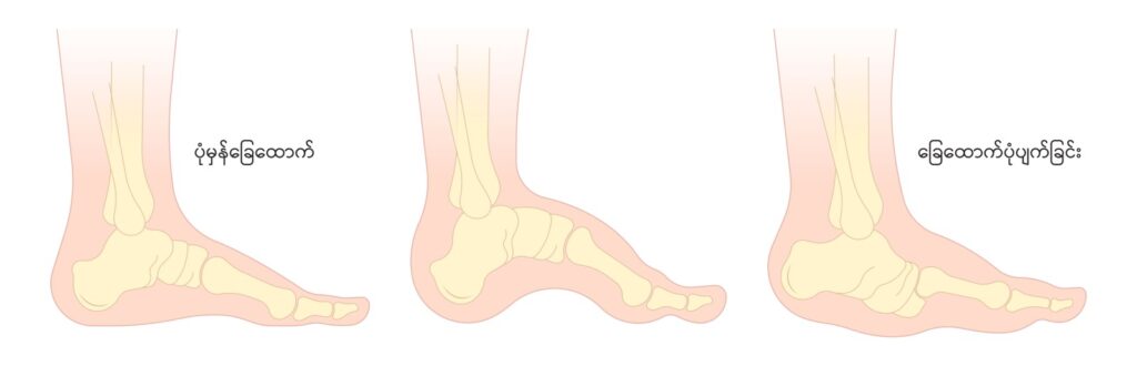 Diabetic foot IMG 2