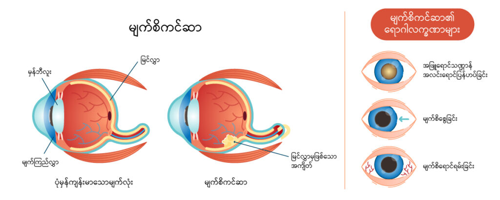 Retinoblastoma IMG 1