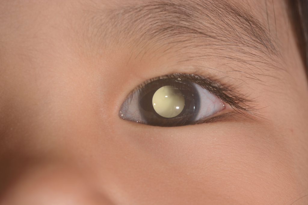 Retinoblastoma IMG 2