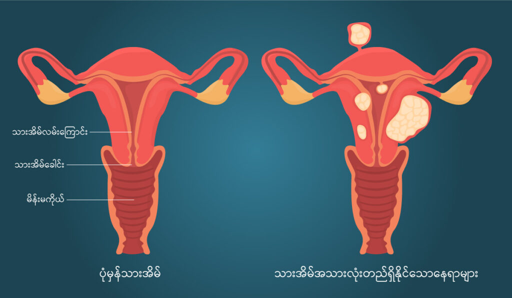 Uterine fibroids IMG