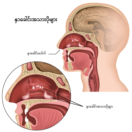 Nasal Polyps IMG