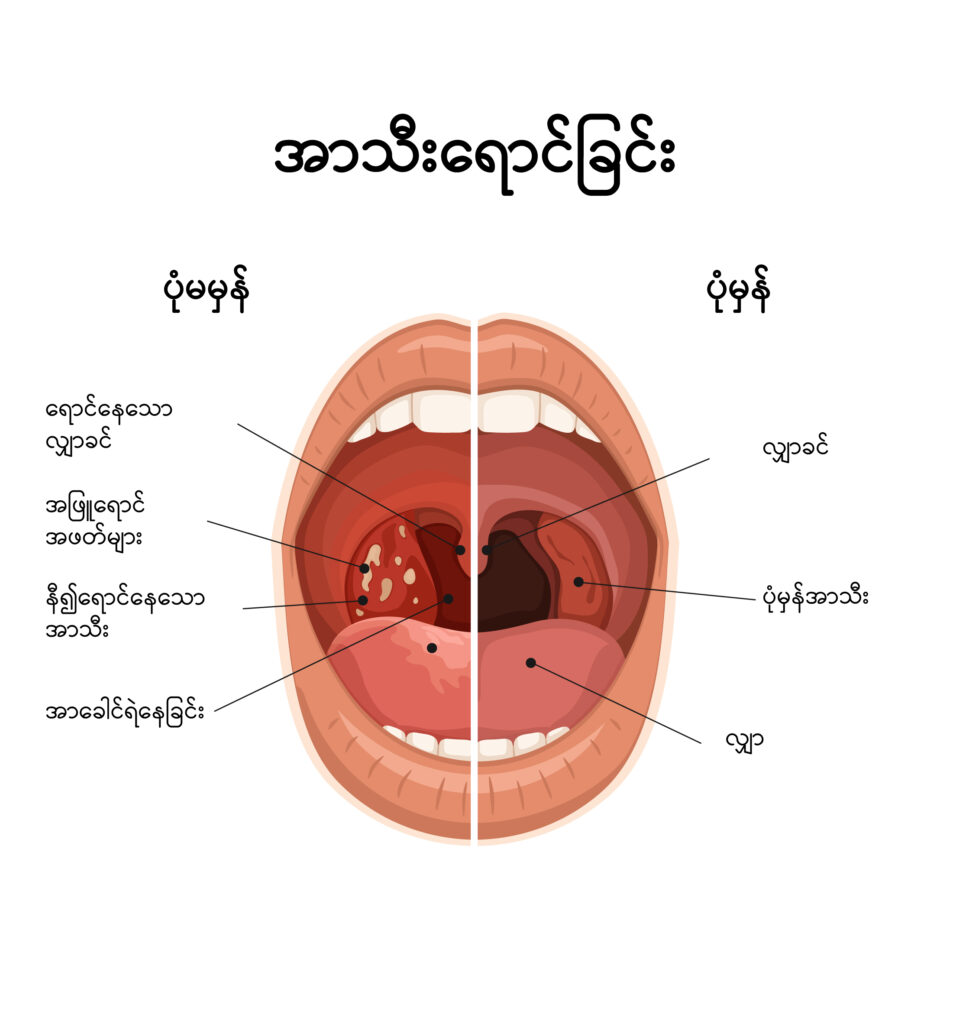 Tonsillitis IMG