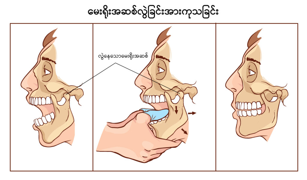 Jaw Dislocation and Jaw Fracture IMG