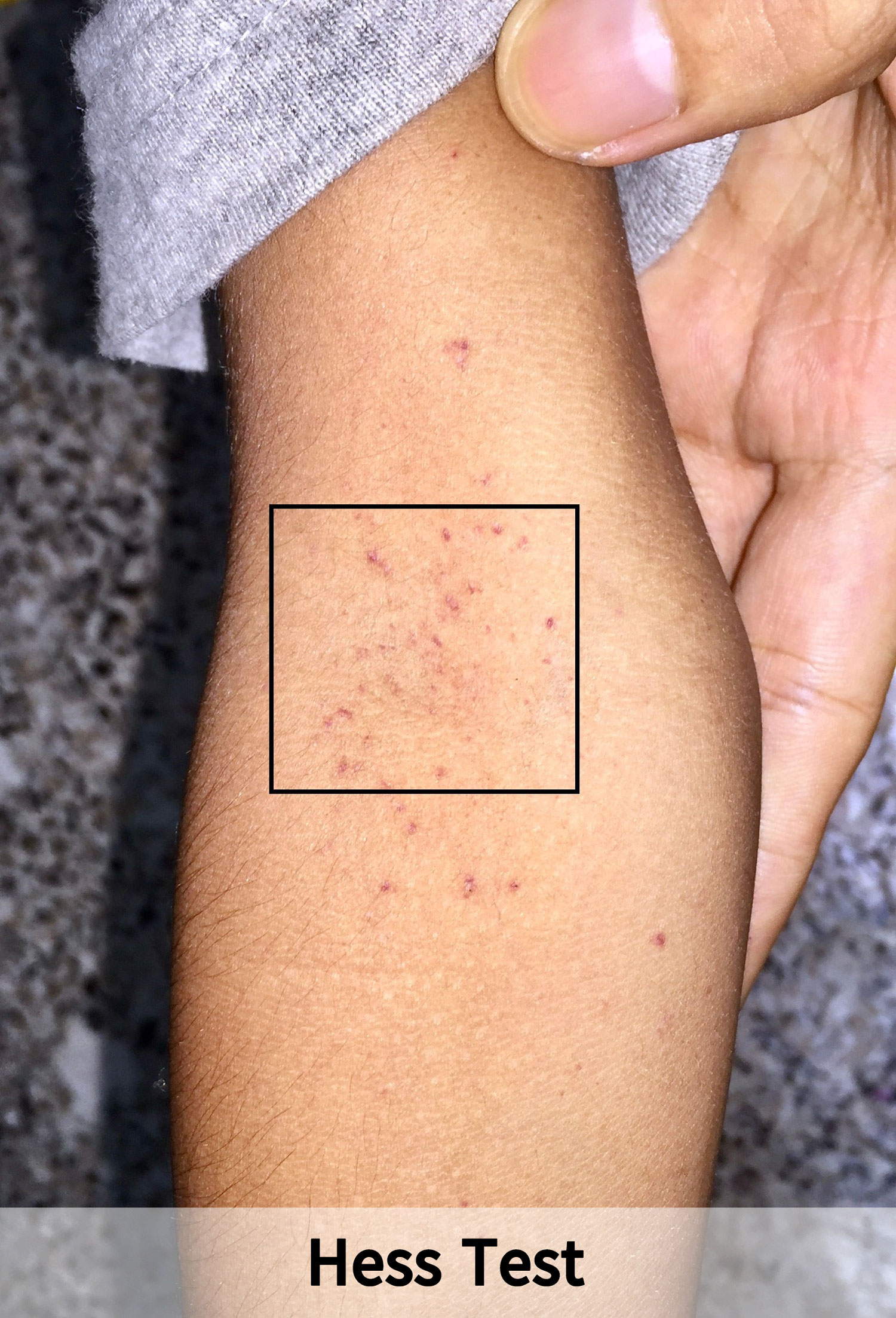 Fever With Rash IMG 