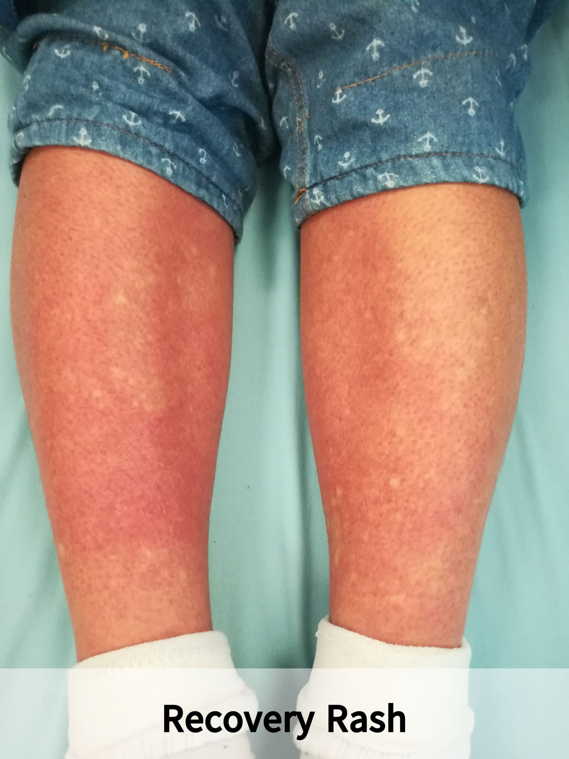 Fever With Rash IMG 