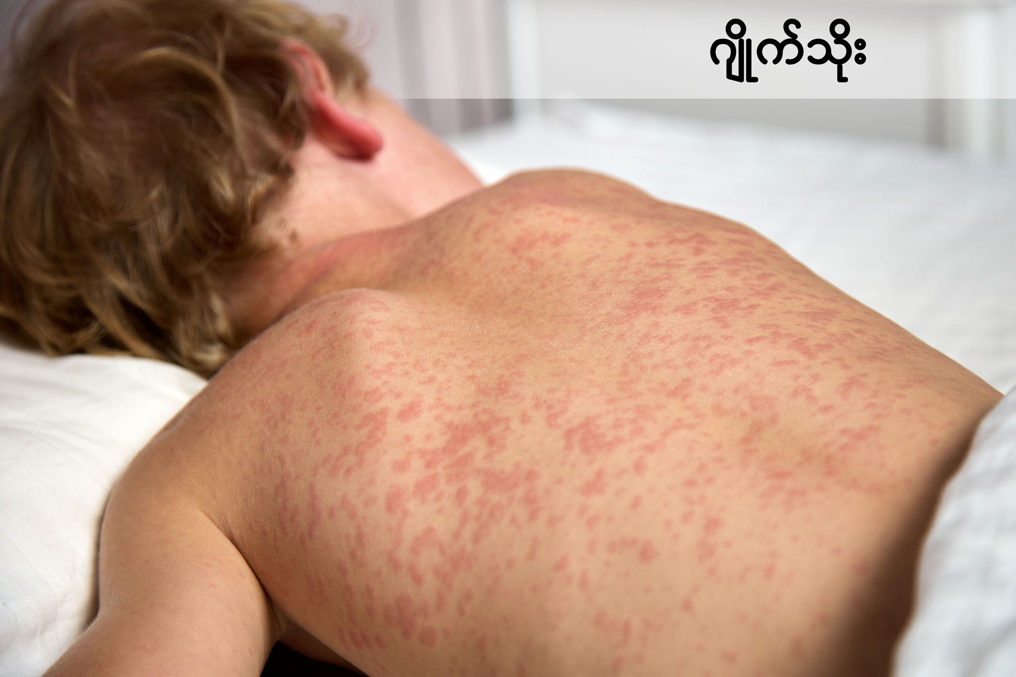 Fever With Rash IMG 