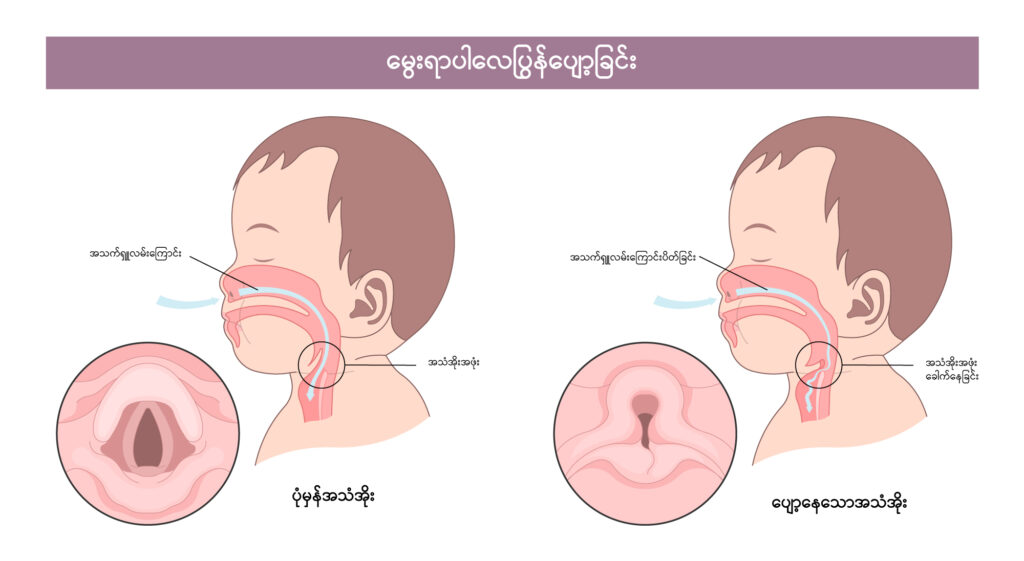 Laryngomalacia img1