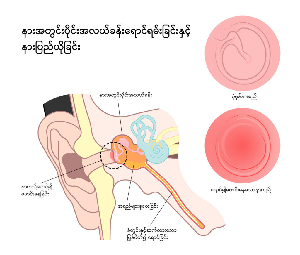 otitis media img1