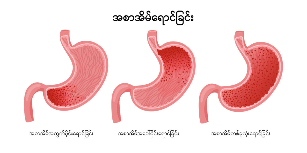 Gastritis img1