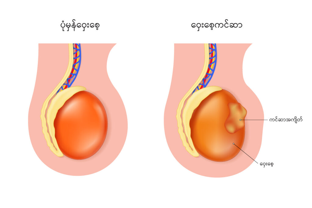 Testicular cancer img1