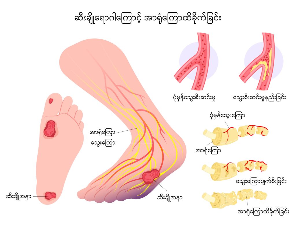 Diabetes long term complications image 1