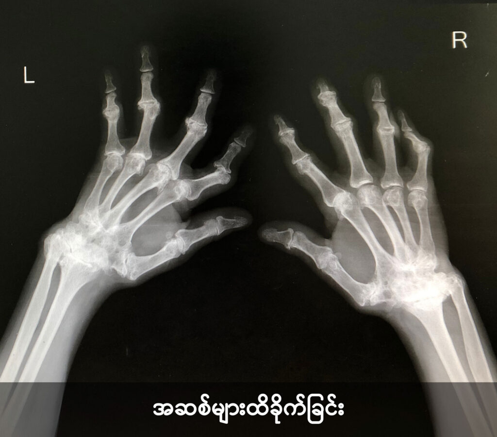 Rheumatoid arthritis image1