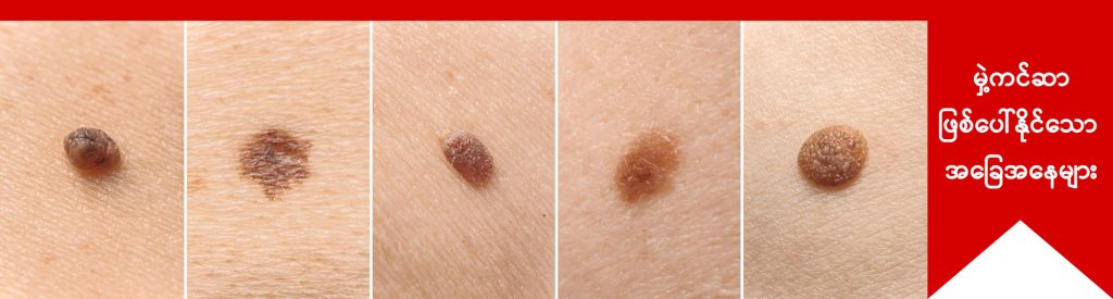 Mole and Melanoma IMG 2