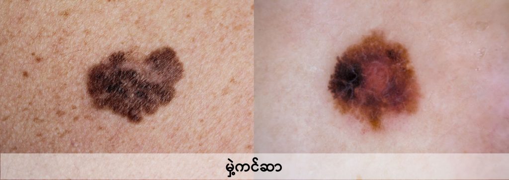 Mole and Melanoma IMG 3