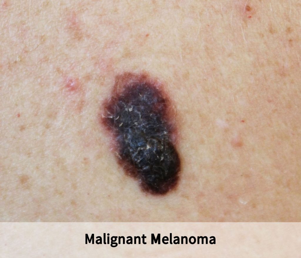 Skin Cancer IMG 3