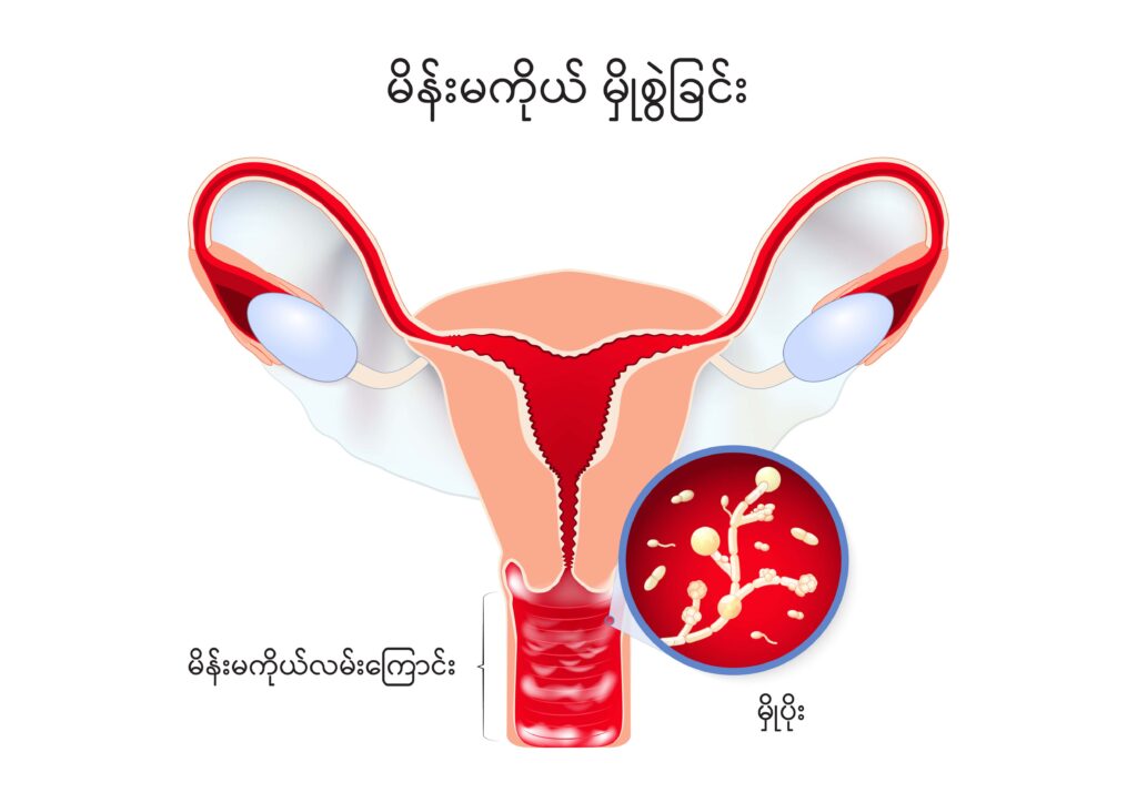 Vaginal Candidiasis IMG1