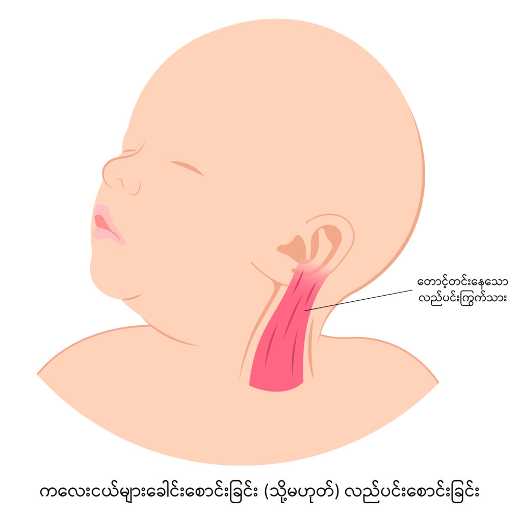 Torticollis IMG2