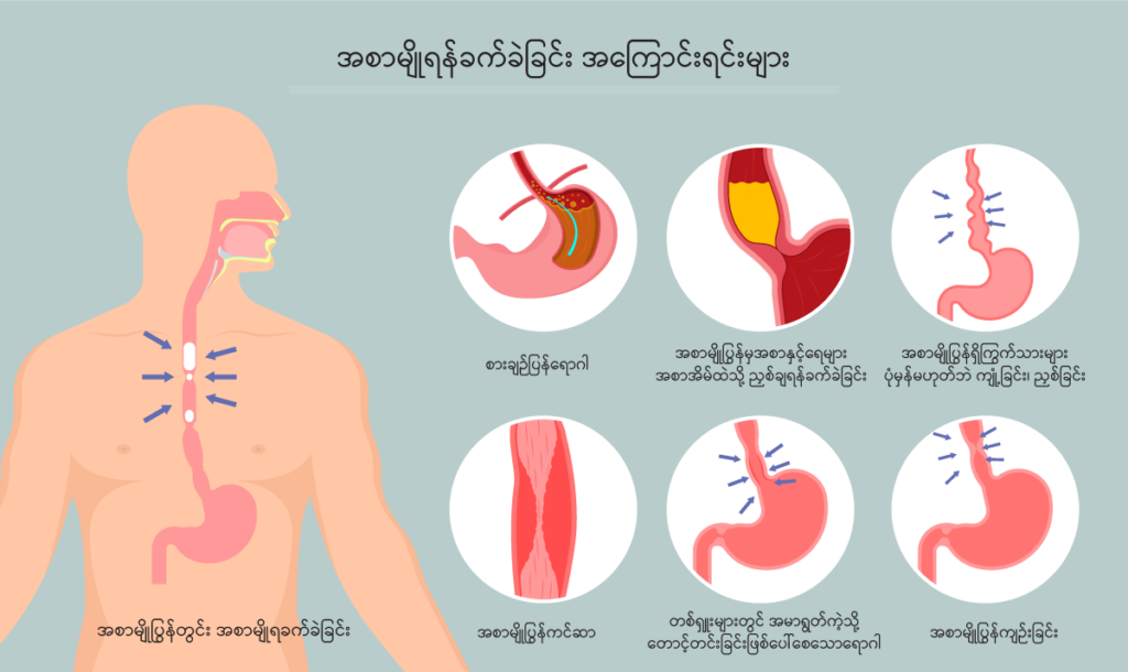 Dysphagia IMG1