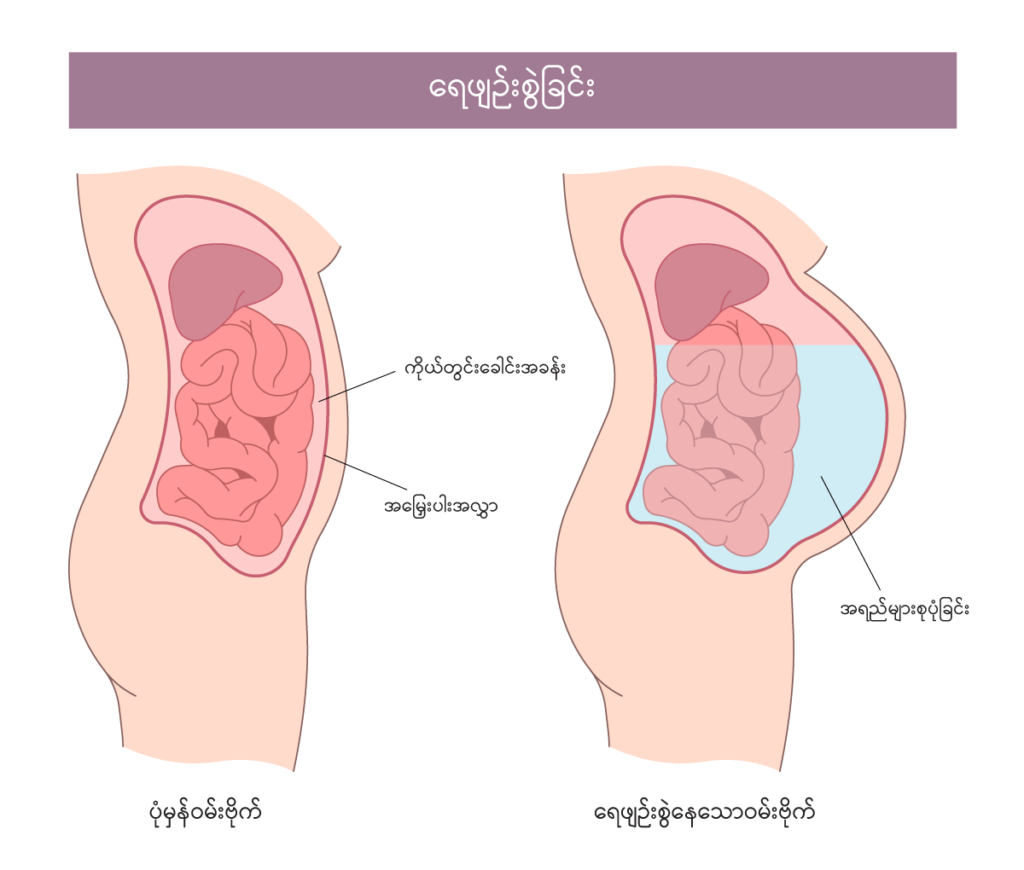 Ascites IMG2