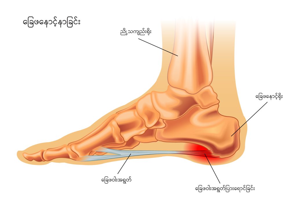 Heel pain image