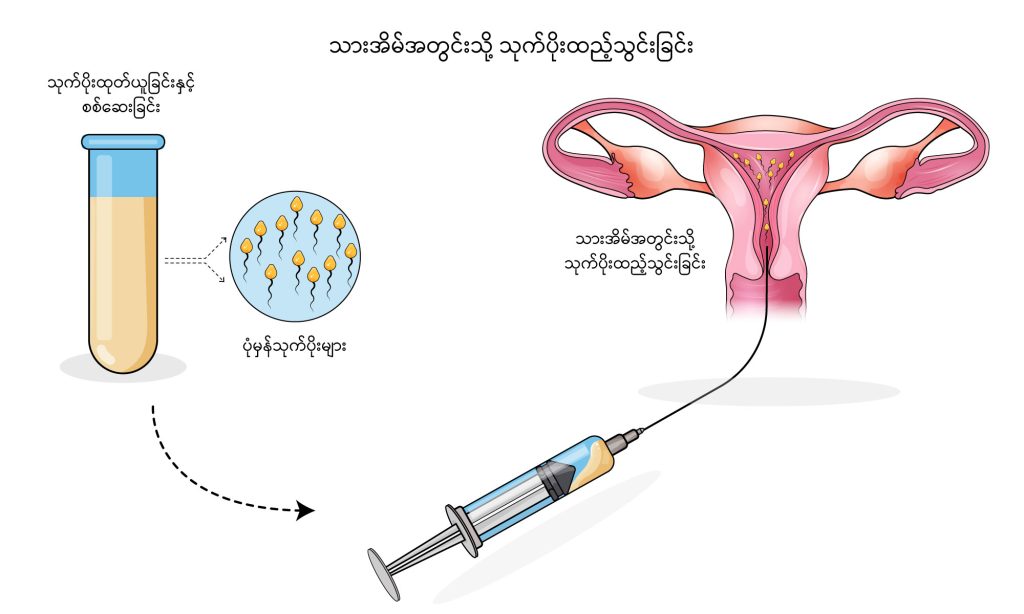 Intrauterine insemination image