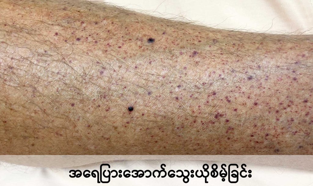 Petechiae and purpura image