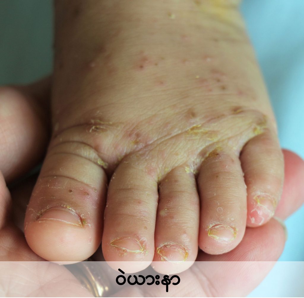 Scabies in children image1