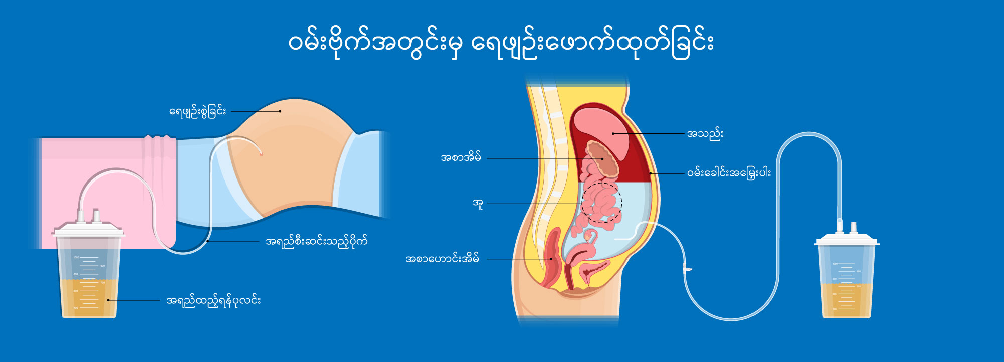 Paracentesis IMG1