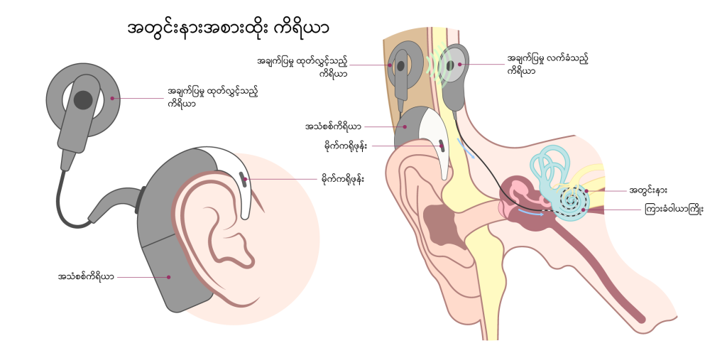 Cochlear implants IMG1