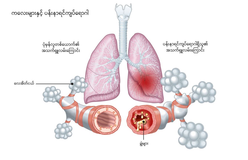 Asthma in children image