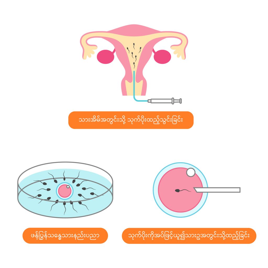 In vito fertilizaiton image1