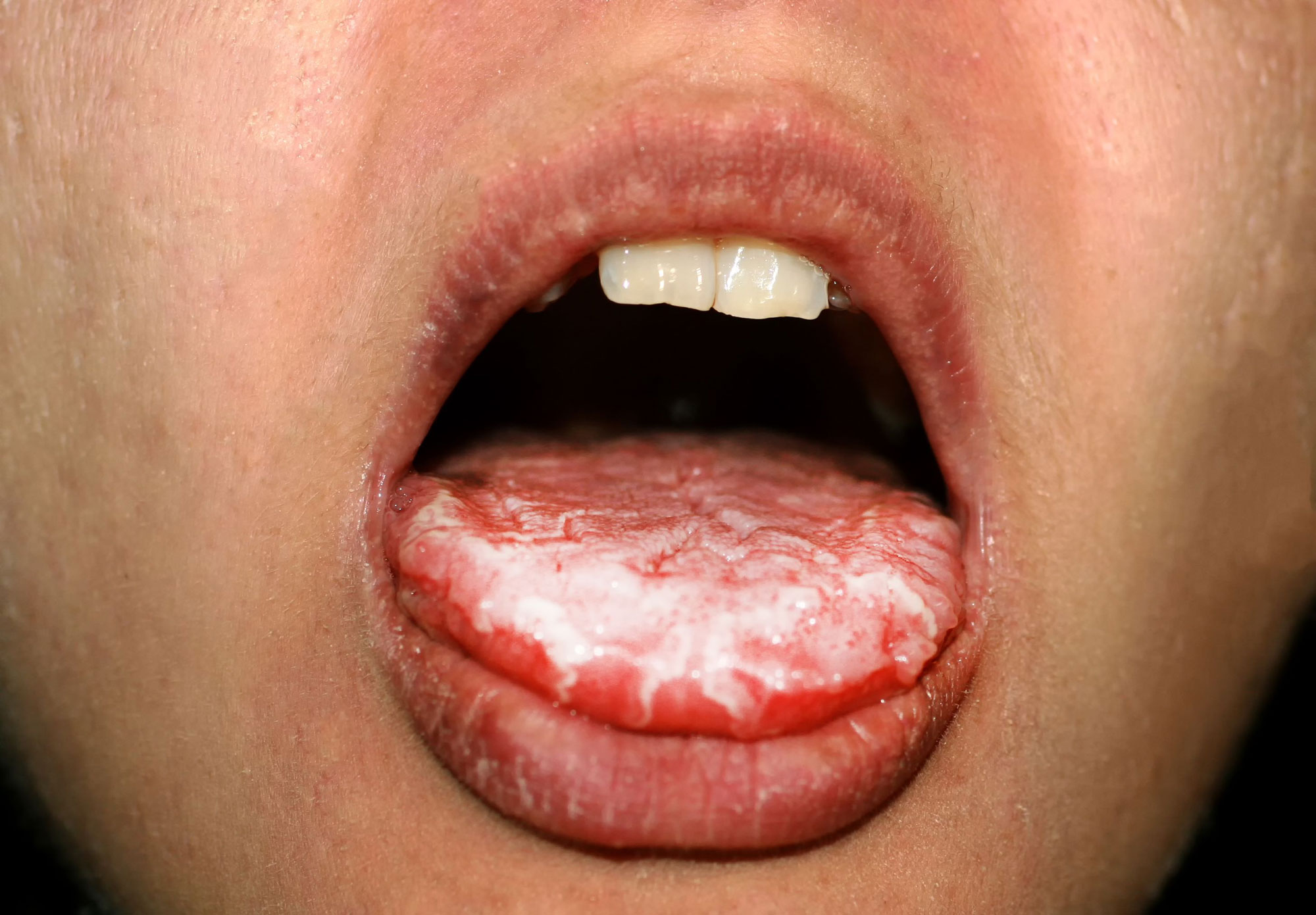 Oral Thrush Image2