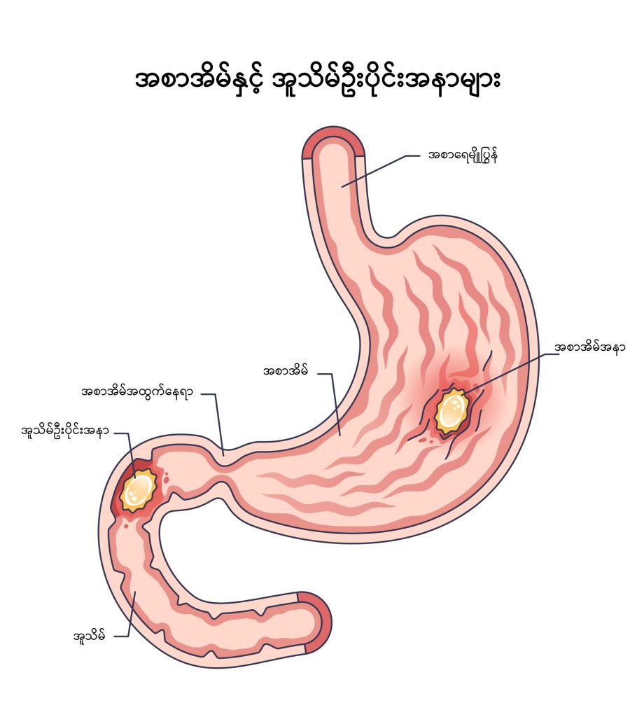 Peptic ulcer disease image