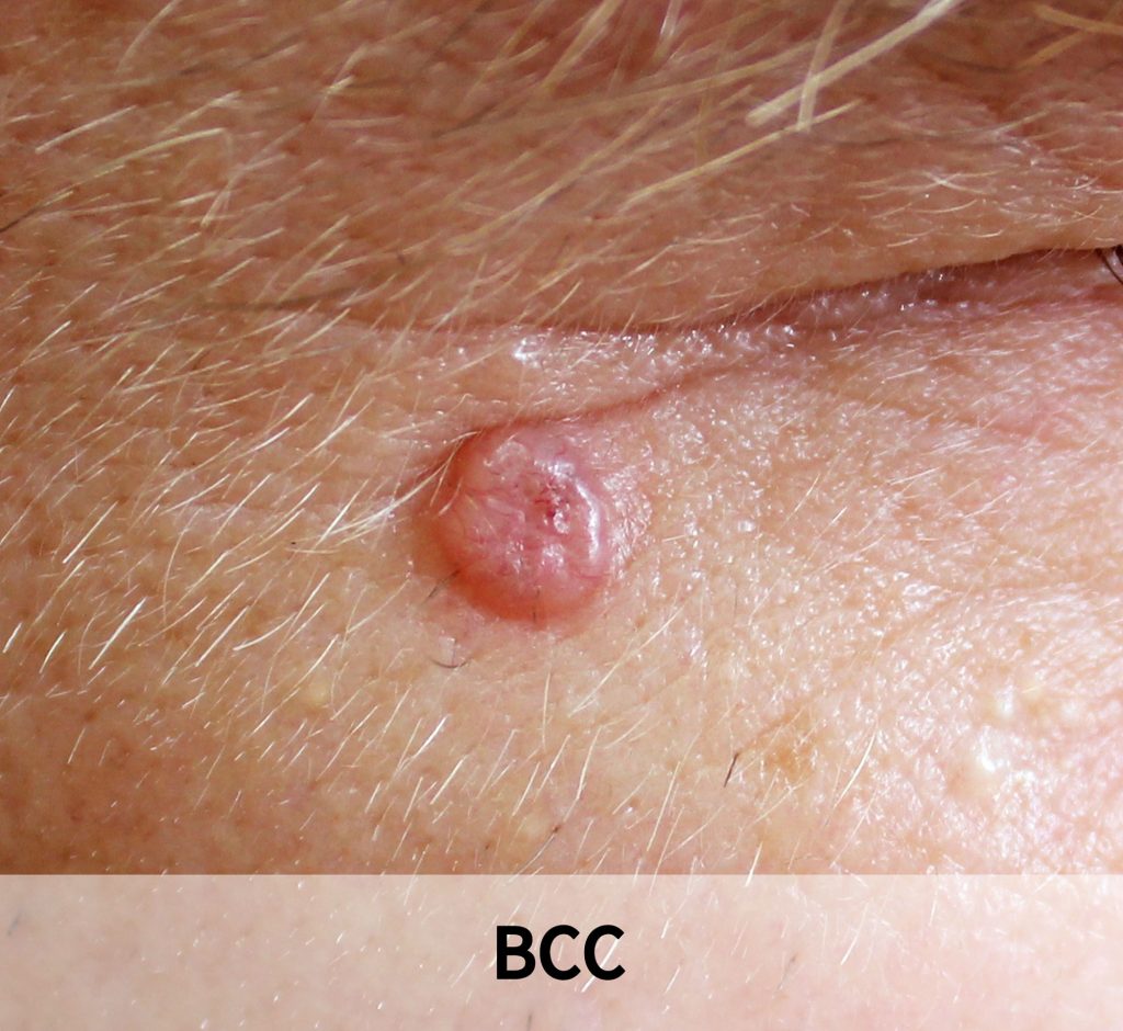 Skin cancer image1