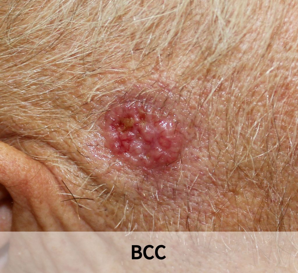 Skin cancer image2