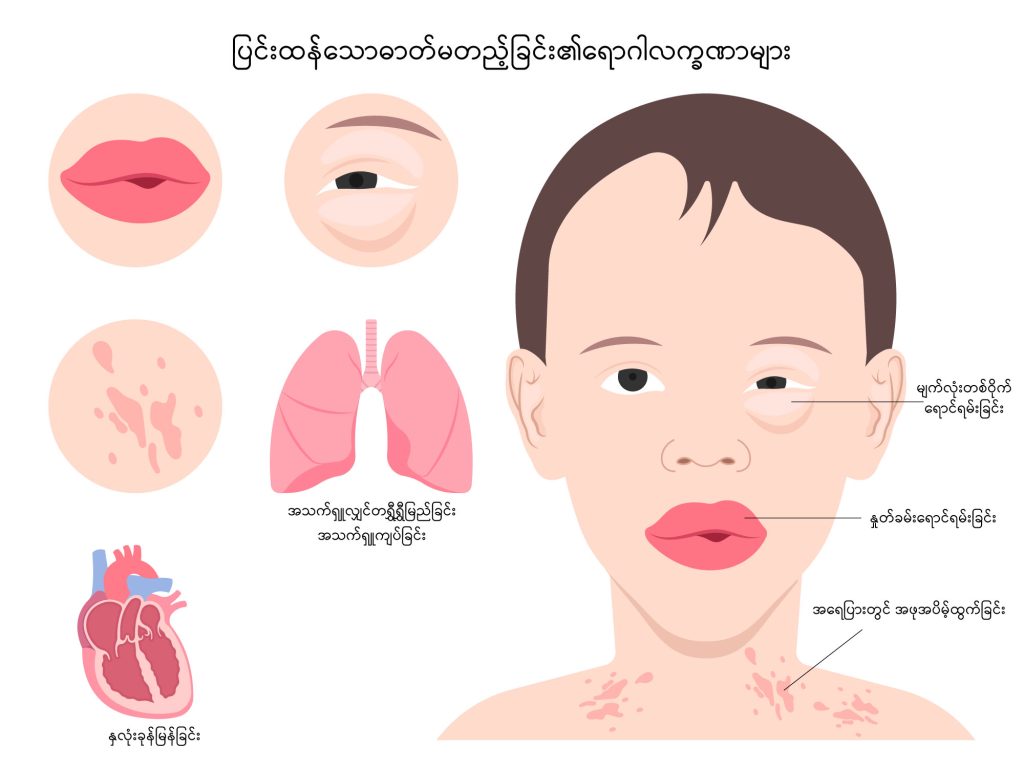 Anaphylaxis image1