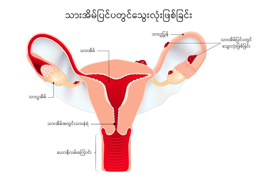 Endometriosis image1