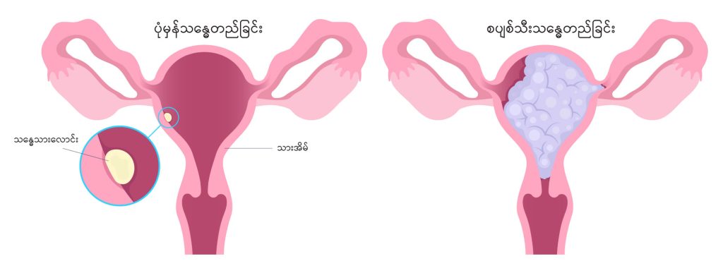 Hydatidiform mole image