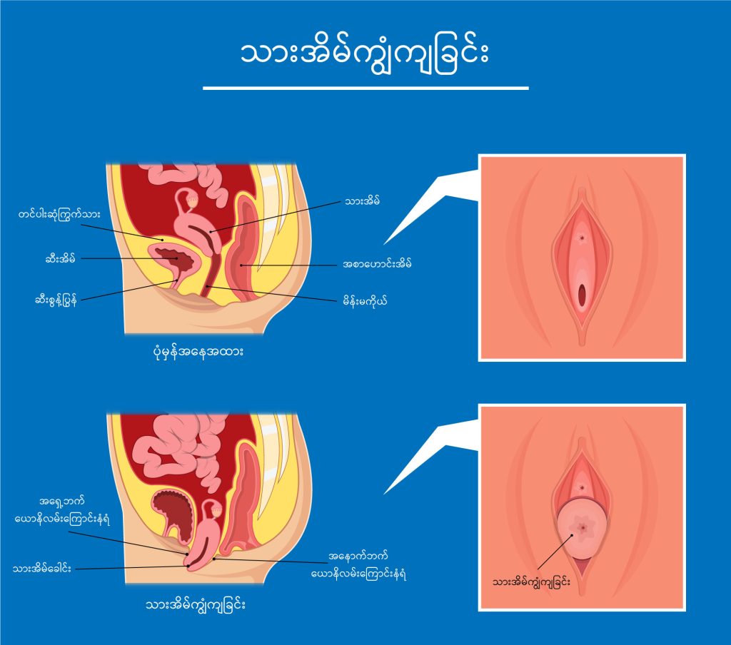 Uterine Prolapse image1