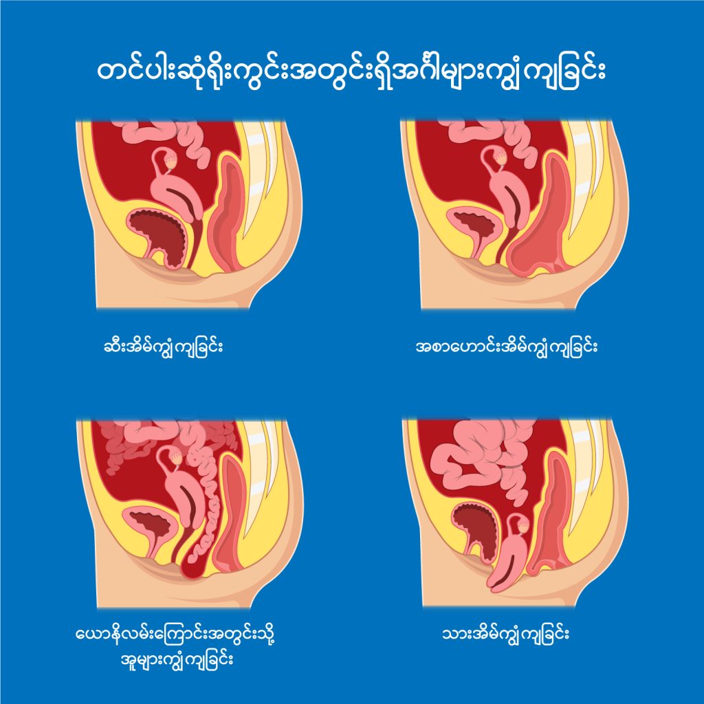 Uterine Prolapse image2