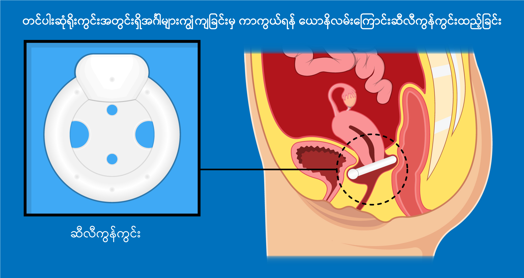 Uterine prolapse image3