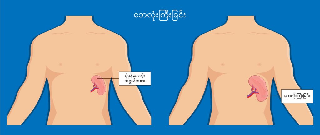 Splenomegaly image