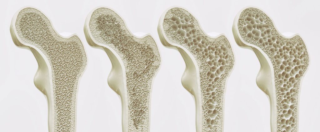 Osteoporosis image1