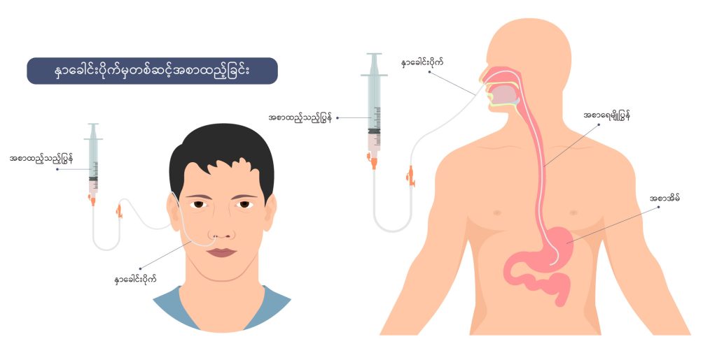 Nasogastric tube image1