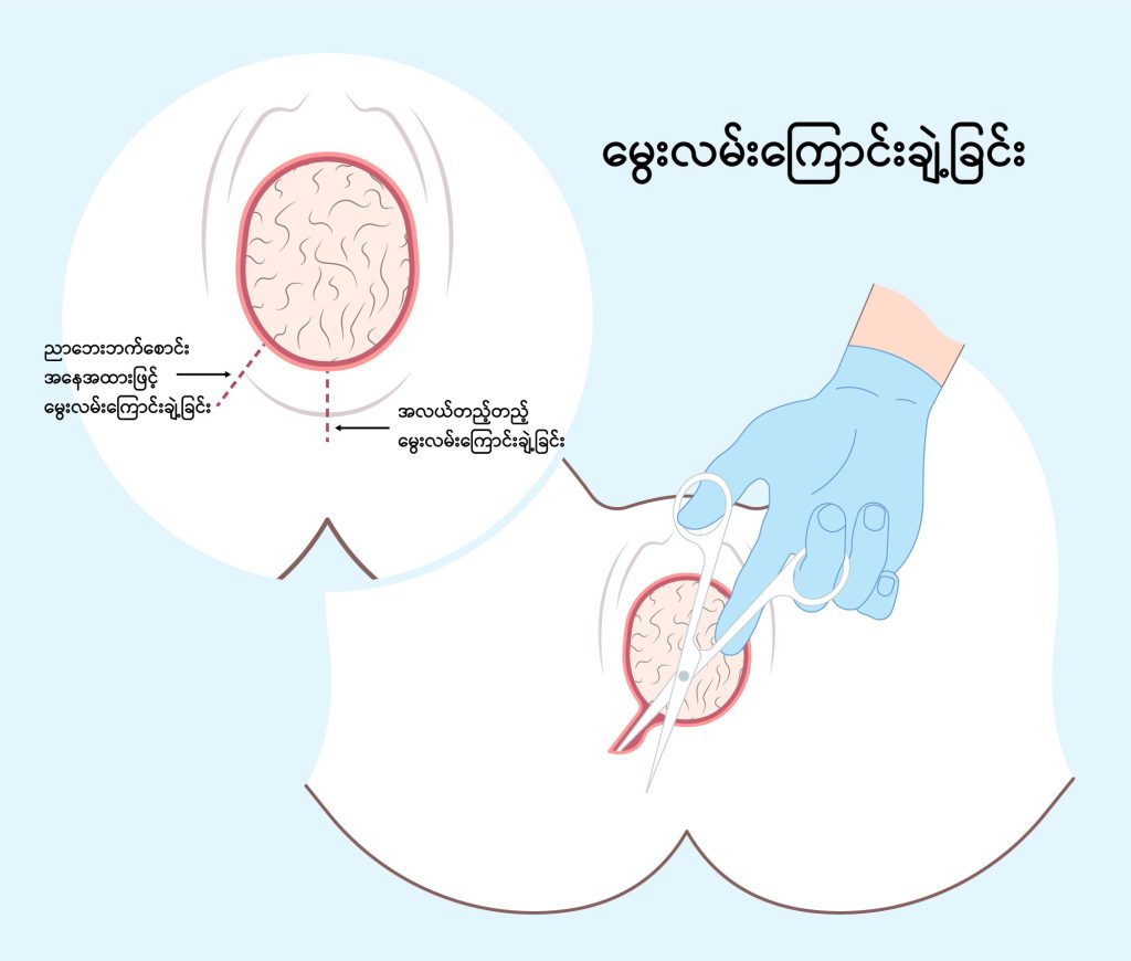 Episiotomy image