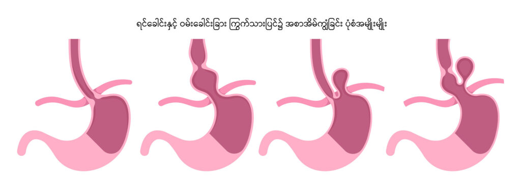 Hernia image 2