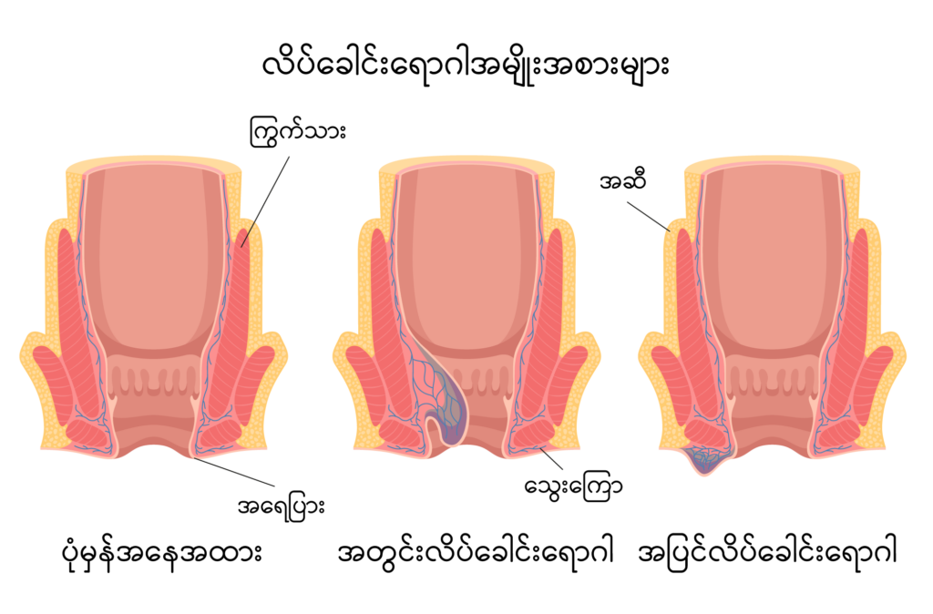 Piles image1