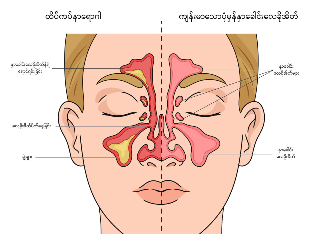 Sinusitis image1